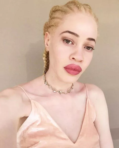 Albinism around the world in pictures - #1 