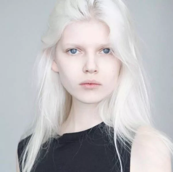 Albinism around the world in pictures