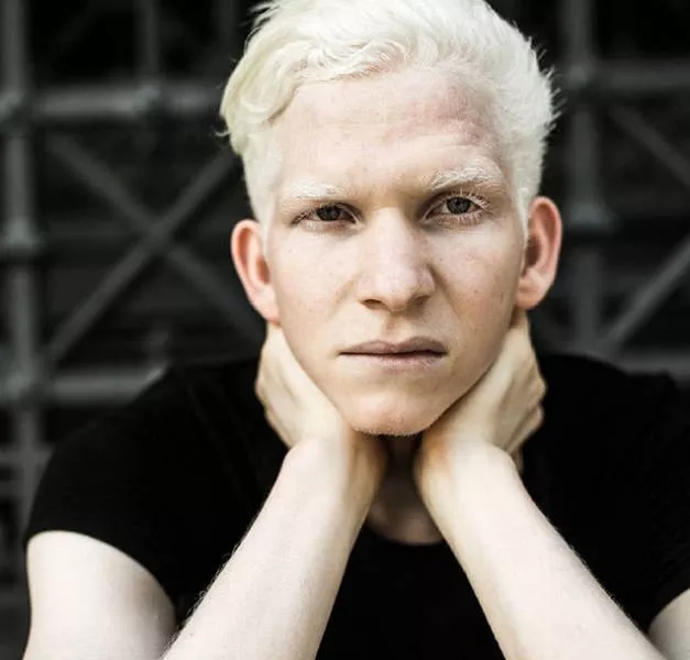 Albinism around the world in pictures - #12 
