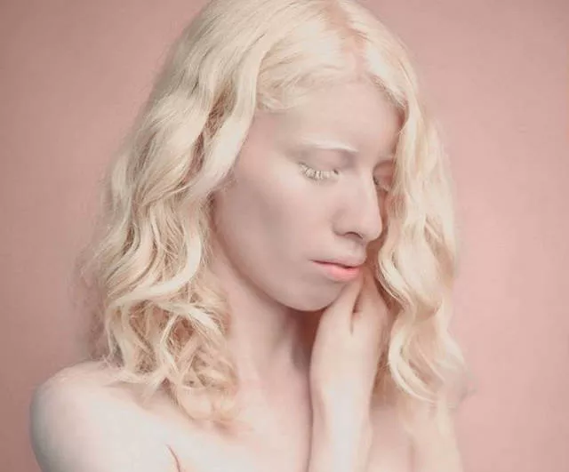 Albinism around the world in pictures - #14 