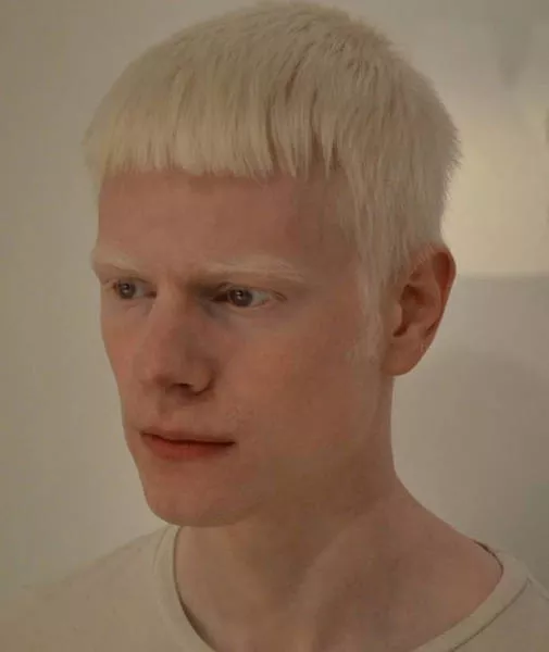 Albinism around the world in pictures - #15 
