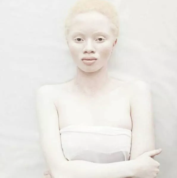 Albinism around the world in pictures - #17 