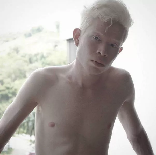 Albinism around the world in pictures - #2 
