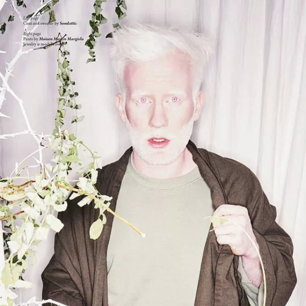 Albinism around the world in pictures - #3 