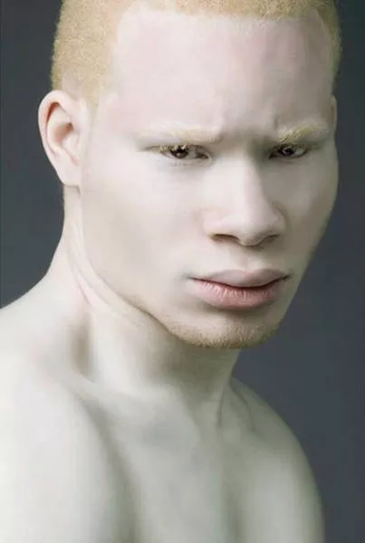 Albinism around the world in pictures - #5 