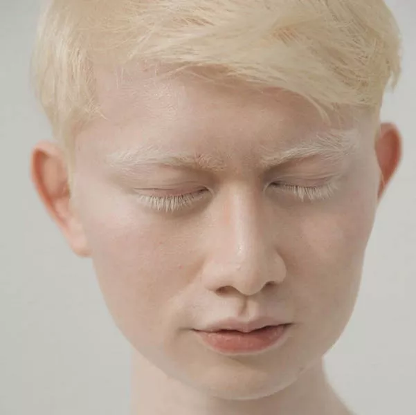 Albinism around the world in pictures - #6 
