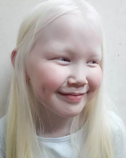 Albinism around the world in pictures - #7 
