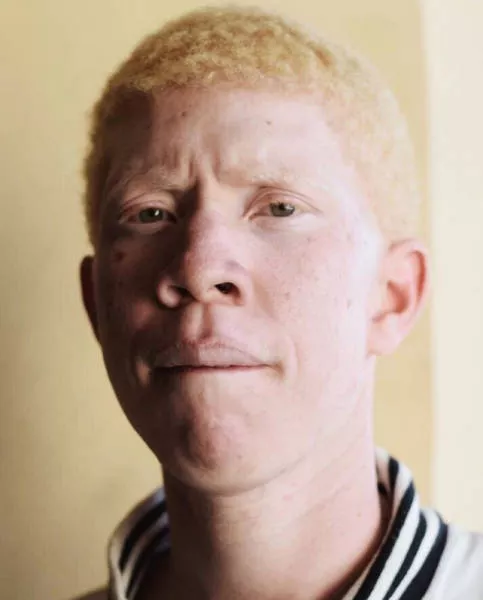 Albinism around the world in pictures - #8 