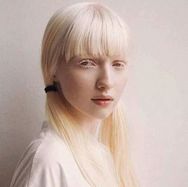 Albinism around the world in pictures - #9 