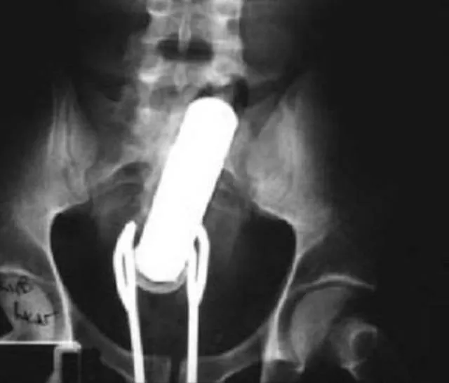 The 3 most terrible x rays in the world - #10 