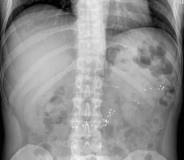 The 3 most terrible x rays in the world - #11 