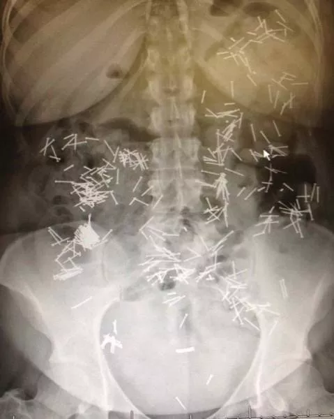 The 3 most terrible x rays in the world - #14 