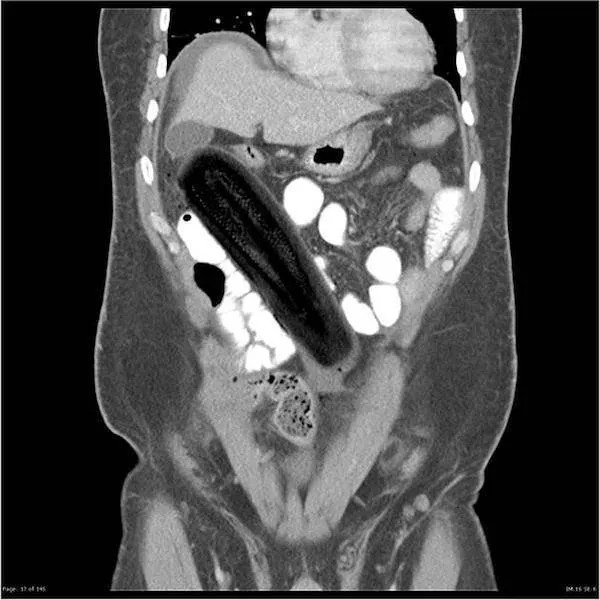 The 3 most terrible x rays in the world - #5 
