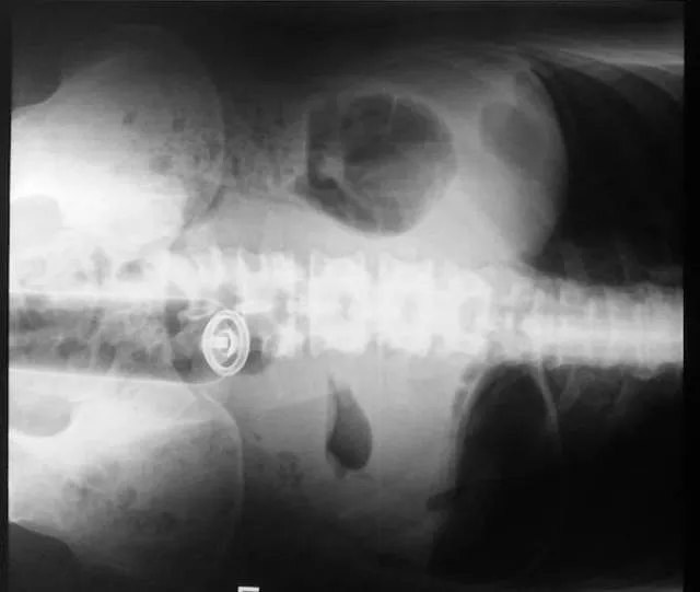 The 3 most terrible x rays in the world - #8 