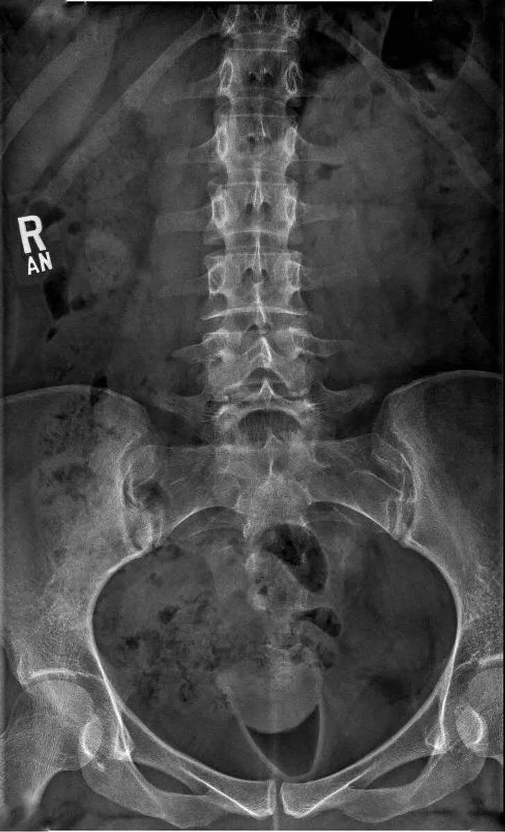 Wonders revealed gaze of discovery - #27 Had an X-ray while wearing a menstrual cup.