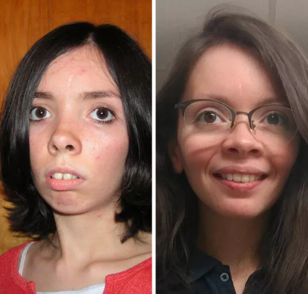 Metamorphic narratives individuals undergoing striking transformations - #12 Dental Odyssey: 17 to 31, Post-Braces and Jaw Surgery