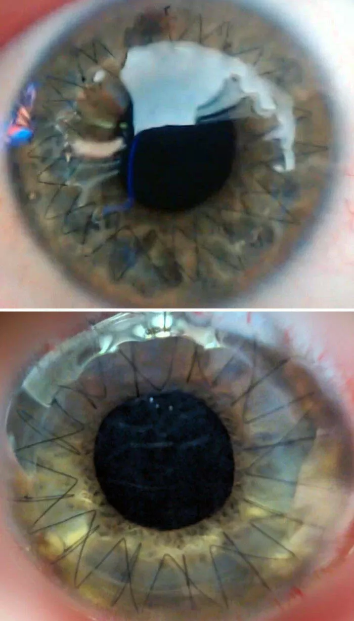 Mind bending perspectives compelling comparison photos to challenge your views - #20 The Discrepancy Between the Stitches in My Eyes from the First and Second Corneal Transplants