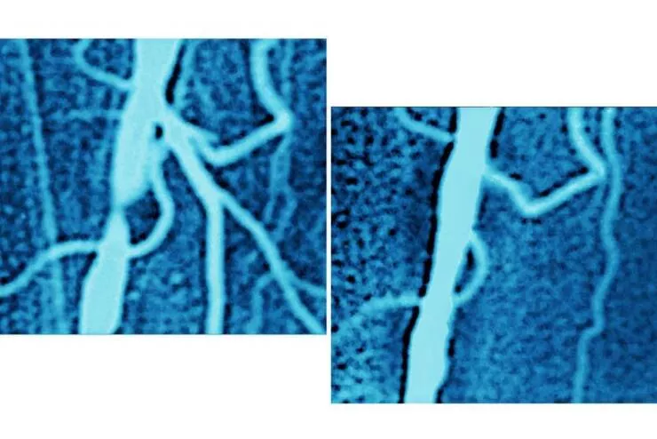 Transformations visuelles captivantes avant apres en images - #25 Et l'artère iliaque d'un patient avant et après une procédure d'angioplastie :