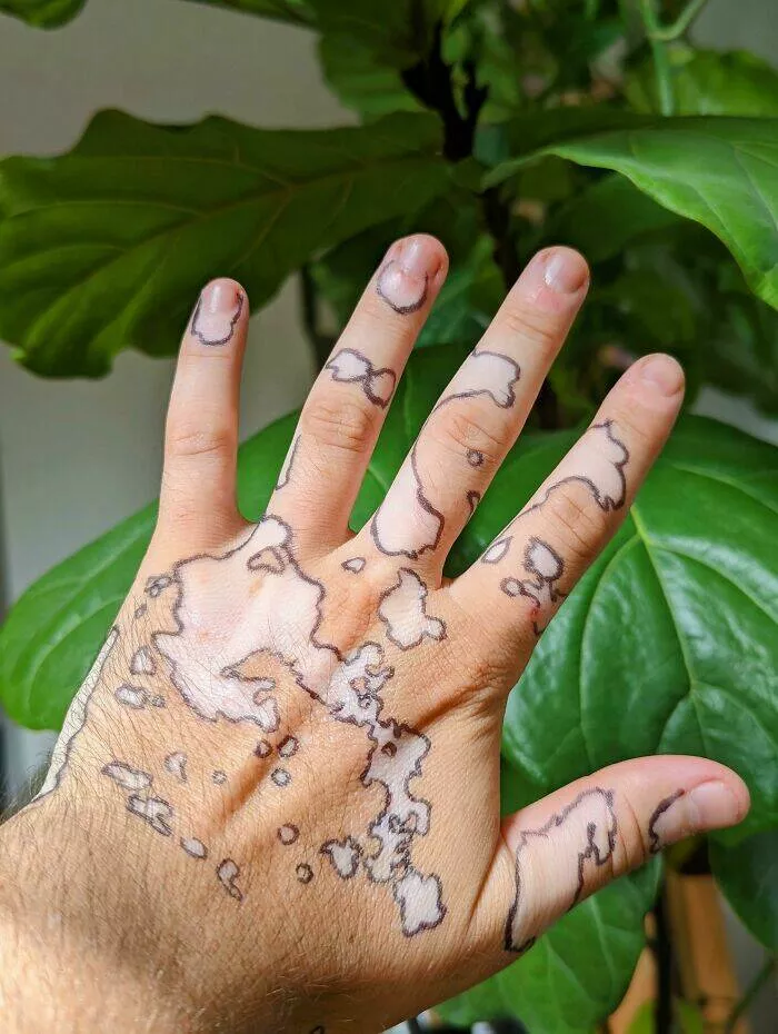 Intriguing discoveries subtly surprising finds that captivate - #46 I traced around my vitiligo spots to create an interesting pattern Intriguing discoveries subtly surprising finds that captivate - #46 I traced around my vitiligo spots to create an interesting pattern