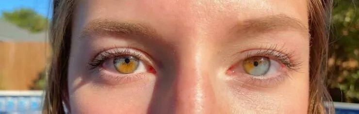 Intriguing discoveries subtly surprising finds that captivate - #48 I have partial heterochromia in both of my eyes Intriguing discoveries subtly surprising finds that captivate - #48 I have partial heterochromia in both of my eyes