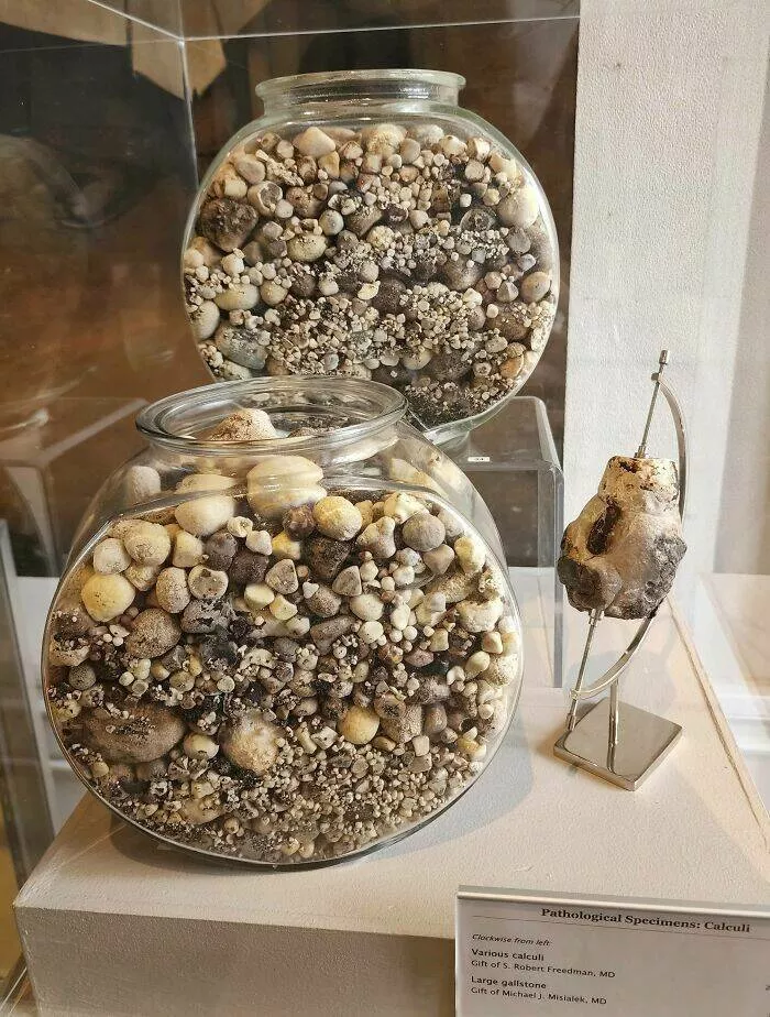 Musees pionniers qui ont revolutionne lexperience des visiteurs - #38 Des bocaux remplis de calculs biliaires et rénaux dans un musée de la chirurgie