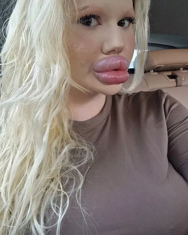 Lip filler queen andrea ivanova - #10 