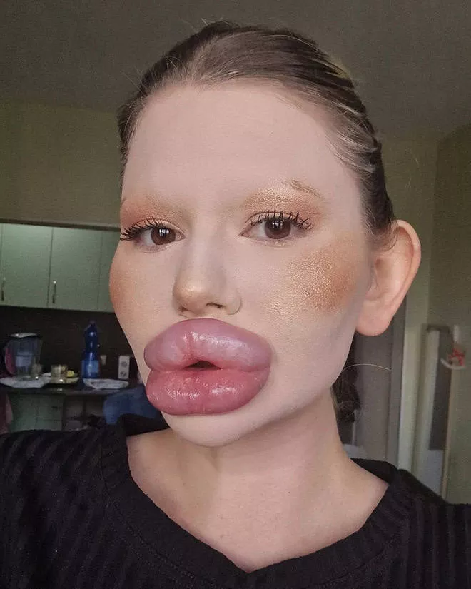 Lip filler queen andrea ivanova - #11 