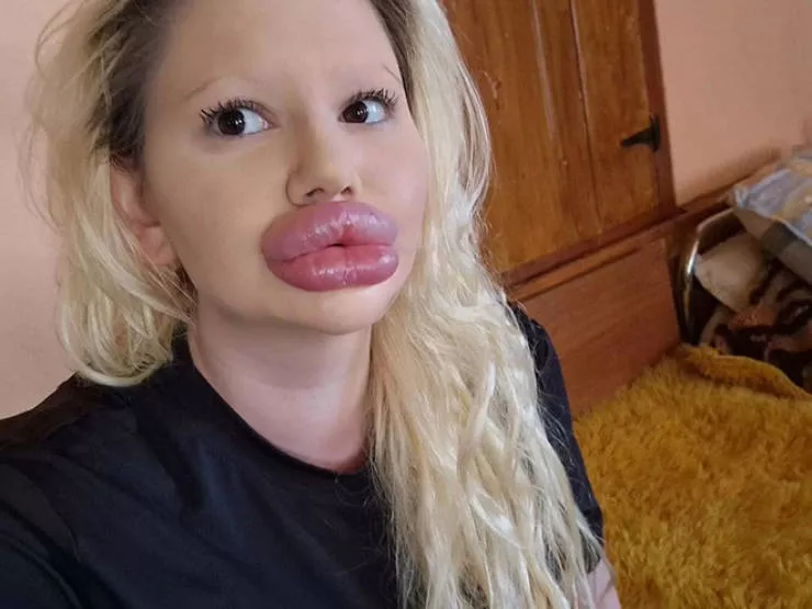 Lip filler queen andrea ivanova - #14 