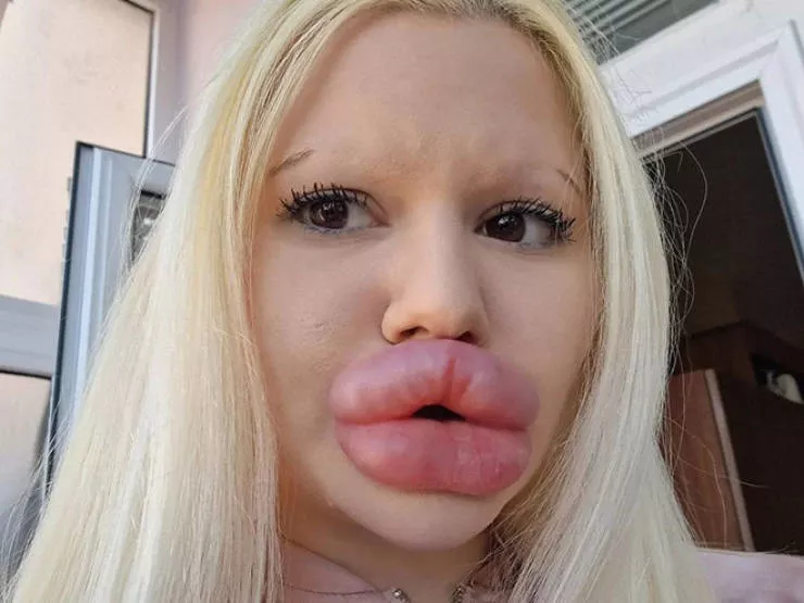 Lip filler queen andrea ivanova - #18 