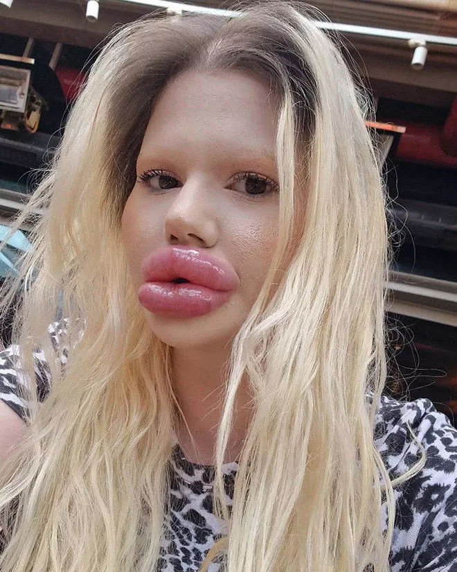 Lip filler queen andrea ivanova - #2 