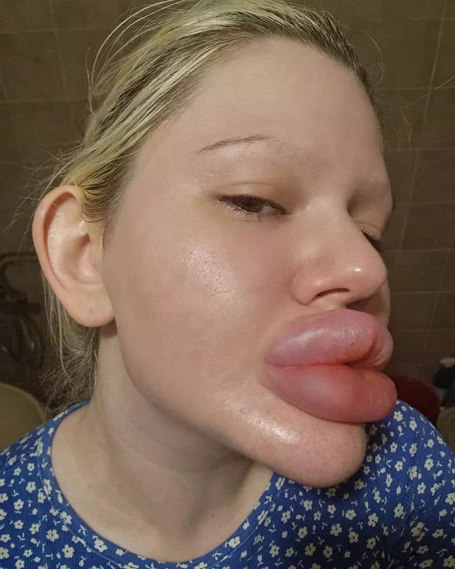 Lip filler queen andrea ivanova - #7 