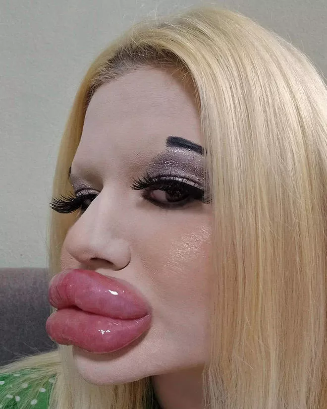 Lip filler queen andrea ivanova - #8 