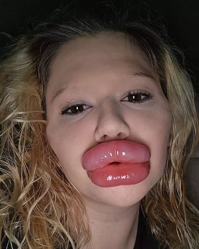 Lip filler queen andrea ivanova
