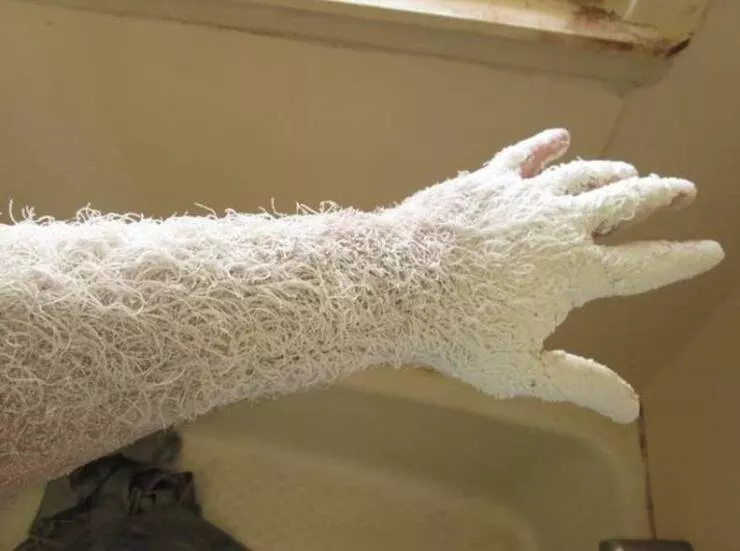 Chilling photos that will haunt your dreams - #19 Zombie Fungus Patient Zero - This person who looks like they’re patient zero for a fuzzy fungus zombie apocalypse. Chilling photos that will haunt your dreams - #19 Zombie Fungus Patient Zero - This person who looks like they’re patient zero for a fuzzy fungus zombie apocalypse.