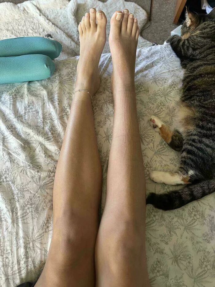 Intriguing photos with amazing stories - #17 Leg Muscle Loss from Ankle Injury Clearly Visible in Size Difference