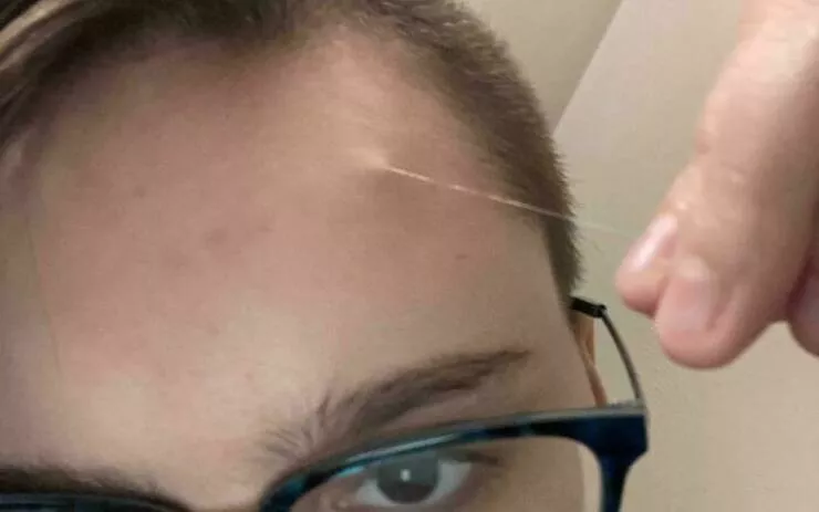 Intriguing photos with amazing stories - #37 Unusually Long Hair Strand Grows from My Forehead