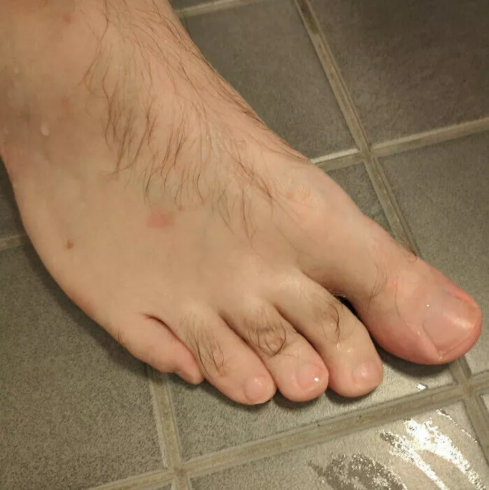 Intriguing photos with amazing stories - #43 My Little Toe Has Shifted Sideways Over the Years