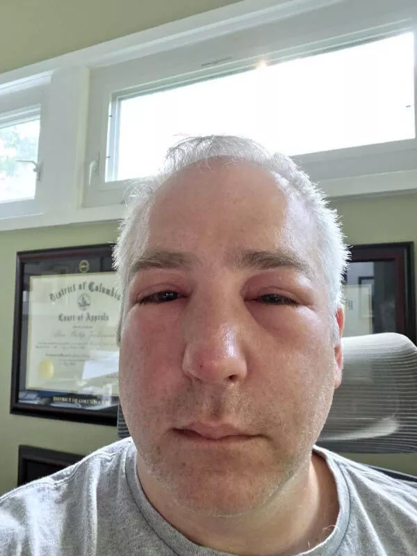 Captivating moments frozen in time - #10 Got stung by a bee on my nose—now I look like I lost a boxing match. Captivating moments frozen in time - #10 Got stung by a bee on my nose—now I look like I lost a boxing match.