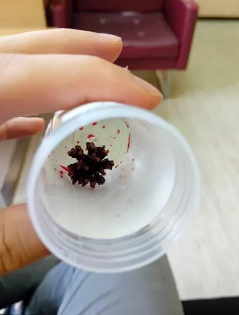 Unseen world stunning new perspectives - #2 The surprising shape of this kidney stone