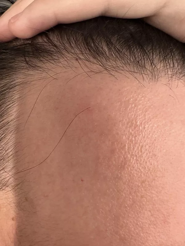 The beauty is in the little things - #13 One hair is still growing at my original hairline